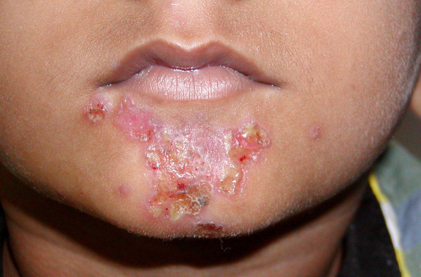 Impetigo - Infected Sores | Seattle Children’s Hospital